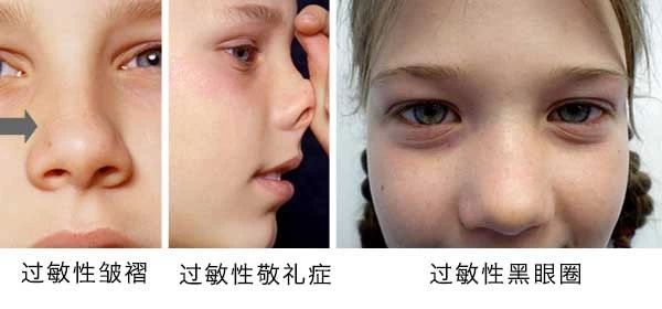 過(guò)敏性鼻炎會(huì)讓孩子變傻？！家長(zhǎng)該如何應(yīng)對(duì)